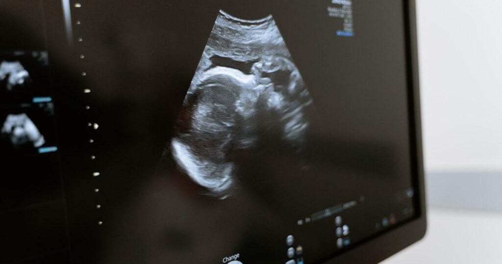 Ultrasound