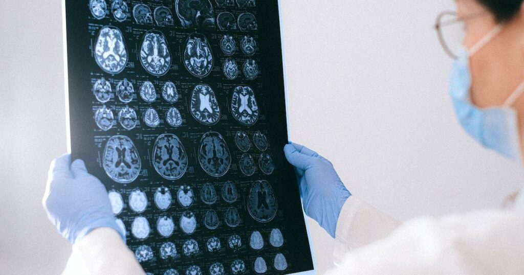 MRI brain scan of aneurysm patient