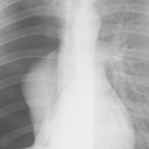 Pneumothorax Types