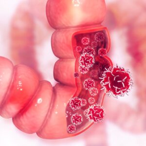 Colon Cancer - Recognizing the Signs