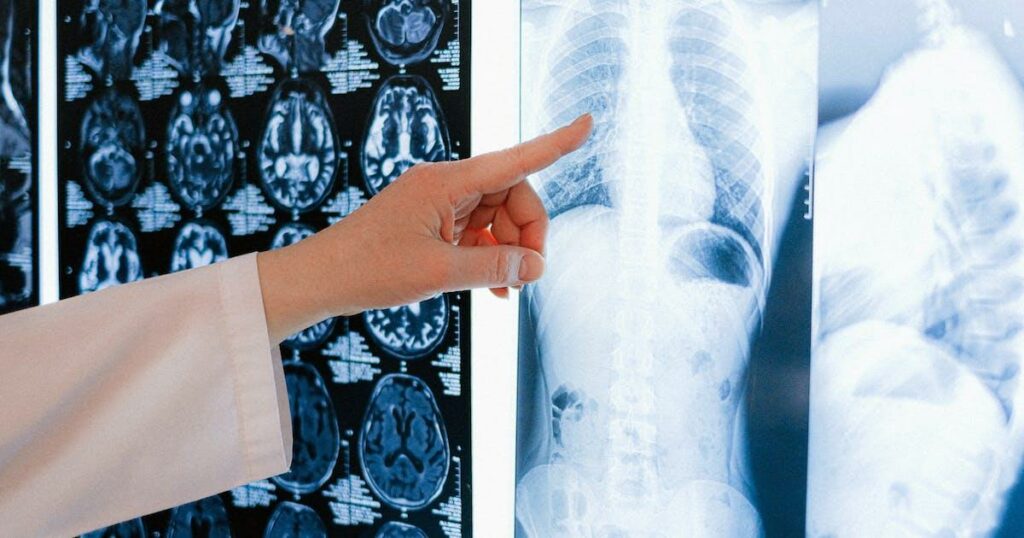 Lung X-Ray of Tuberculosis Patient